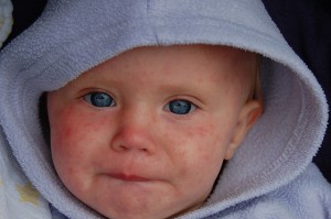 Impfgegnern auch in Österreich egal: Leidende Kinder. (Foto: DAve Haygrath/ Flickr)
