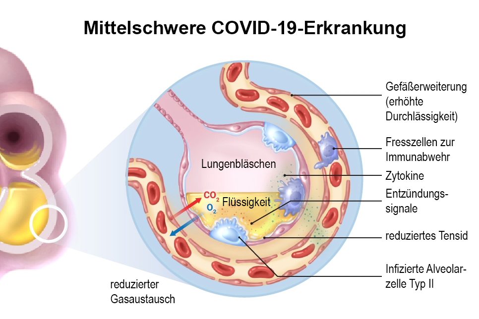 Mittelschwere COVID-19-Erkrankung