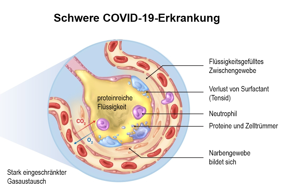 Schwere COVI-19-Erkrankung